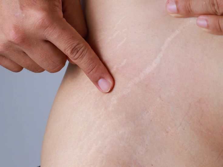 Everything youve ever wanted to know about stretch marks but have been too afraid to ask.jpg